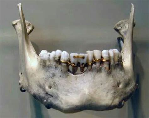 ancient metal bracket|ancient tooth braces.